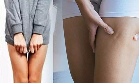 தொடைகளின் இடுக்கில் இருக்கும் கருமை நிறம் போக்க சில டிப்ஸ்....