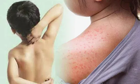 வியர்க்குருவில் இருந்து குழந்தைகளை பாதுகாப்பது எப்படி?