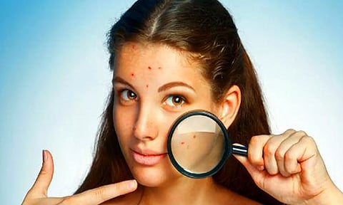 30 நாட்களில் தழும்புகள், பருக்கள் மறைய இதை செய்து பாருங்கள்!