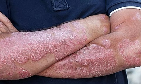 சொரியாசிஸ் நோய்க்கான சித்த மருத்துவ தீர்வு