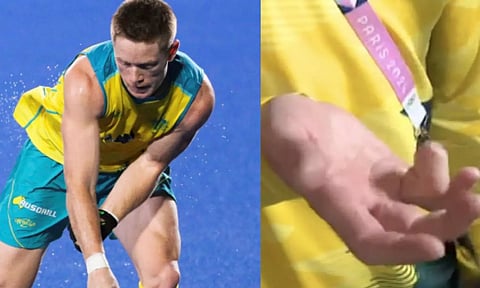 விளையாட்டுக்காக விரலை தியாகம் செய்த இளம் ஹாக்கி வீரர் மாட் டாசன்.. நெகிழ்ச்சி!