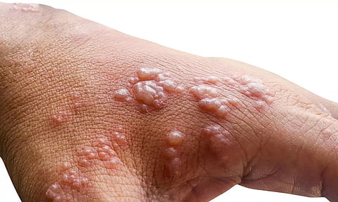 குரங்கம்மை நோயின் அறிகுறிகள் என்ன?