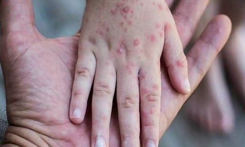 குரங்கம்மை: அச்சுறுத்தல்களும்.. அபாயங்களும்..!