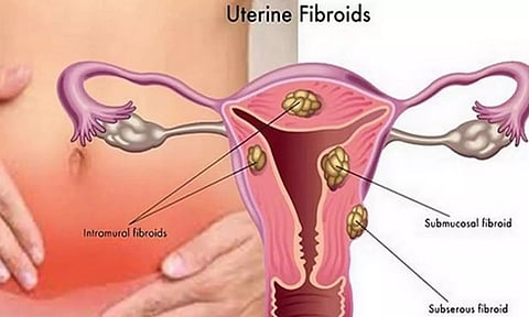பெண்களை பாதிக்கும் சினைப்பை நீர்க்கட்டி பிரச்சனைகள்