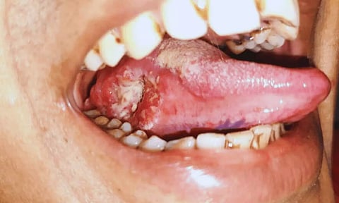 வாய் புற்றுநோய் அறிகுறிகள்