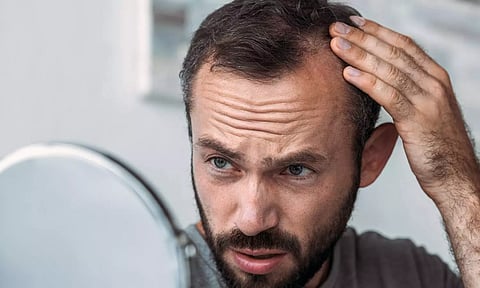 தலைமுடி அதிகம் கொட்டி வழுக்கை விழ ஆரம்பிக்கிறதா?...இந்த டிப்ஸ் உங்களுக்கு தான்