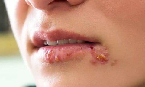 வாய்ப்புண் மற்றும் உதடு வெடிப்பு குணமாக எளிய வீட்டு வைத்தியம்