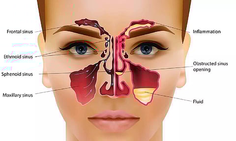 சைனசைட்டிஸ் பிரச்சினை என்றால் என்ன?