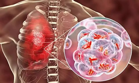 குளிர்காலத்தில் அதிகம் பரவும் `வாக்கிங் நிமோனியா'