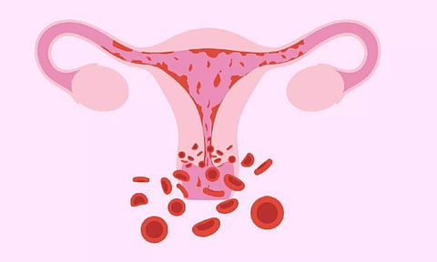 மாதவிடாய் காலத்தில் அதிக உதிரப்போக்கு ஏற்படுவது எதனால்?