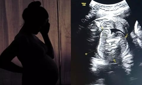 கர்ப்பிணிப் பெண்ணின் வயிற்றில் உள்ள குழந்தைக்குள் வளரும் கரு.. ஆச்சர்யத்தில் மருத்துவர்கள்!
