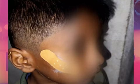 சிறுவனின் காயத்திற்கு Feviquick தடவிய நர்ஸ்