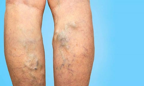 சர்க்கரை நோய் உள்ளவர்களுக்கு வெரிகோஸ் வெயின் ஏற்படுமா?