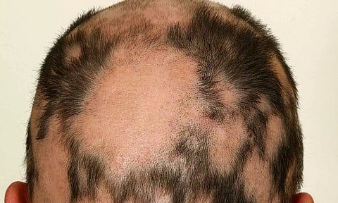 தலையில் பூச்சிவெட்டு, புழுவெட்டு ஏற்பட என்ன காரணம் தெரியுமா?