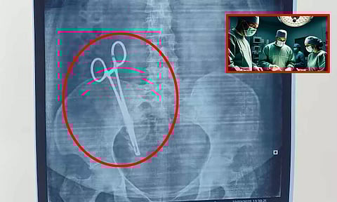 பெண்ணின் வயிற்றுக்குள் வைத்து தைக்கப்பட்ட கத்தரிக்கோல்.. 17 ஆண்டுகளுக்கு பின் அகற்றம்