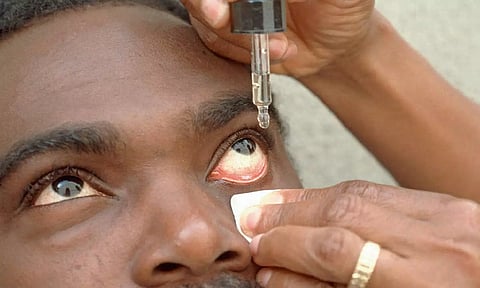 சென்னையில் வேகமாக பரவுகிறது மெட்ராஸ்-ஐ... தடுக்கும் வழிகள் குறித்து டாக்டர் கருத்து