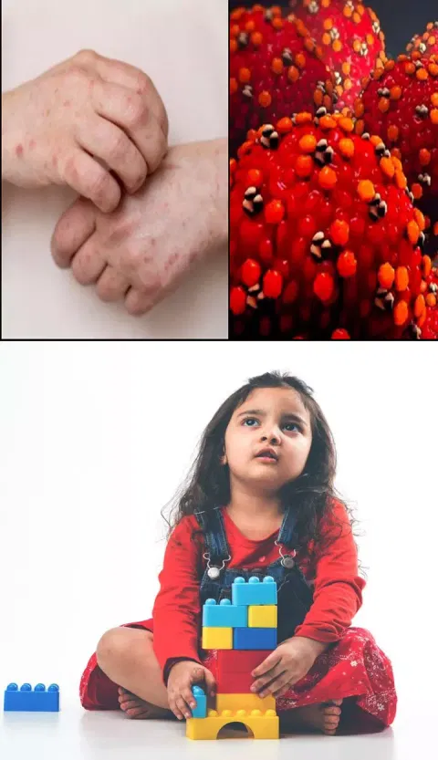 குழந்தைகளை தாக்கும் `தக்காளி காய்ச்சல்'- டாக்டர்கள் எச்சரிக்கை