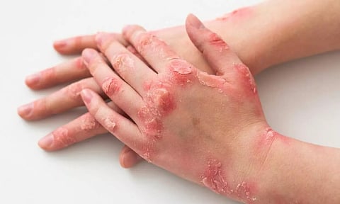 வியர்க்குருவிற்கும் சர்க்கரை நோய்க்கும் இடையே தொடர்பு இருக்கிறதா?