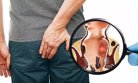 மூல நோய் எதனால் ஏற்படுகின்றது?