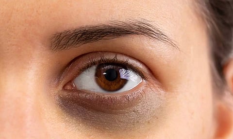 கண்ணை சுற்றி கருவளையமா கவலையை விடுங்க... உங்களுக்காக சில டிப்ஸ்