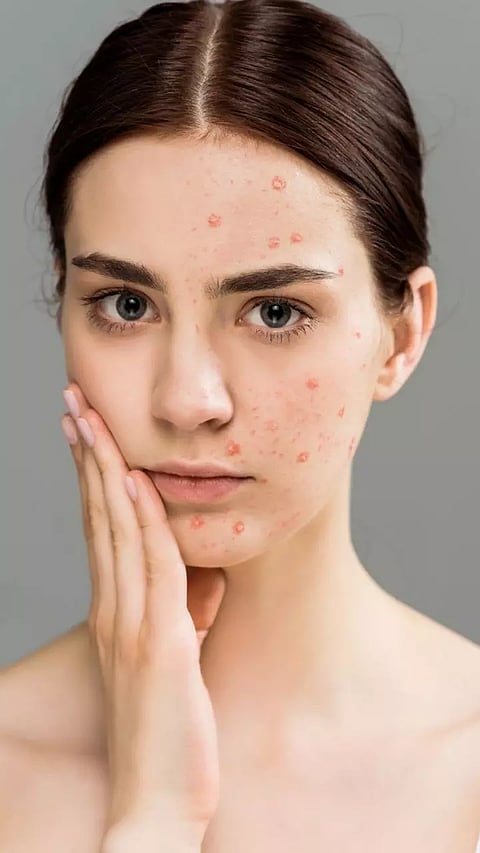 முகத்தில் இங்கே பருக்கள் இருக்கா? அப்போ உடனே இதை கவனிங்க!