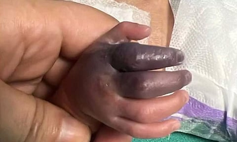 உத்தரபிரதேசத்தில் தவறான ஊசியால் பச்சிளம் குழந்தைக்கு நேர்ந்த கொடூரம்