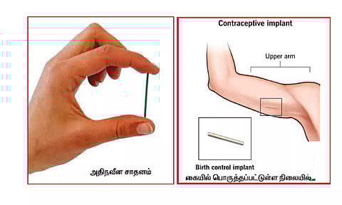 பெண்களுக்கான நவீன இலவச கருத்தடை சாதனம் அறிமுகம்