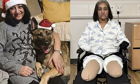 வளர்ப்பு நாய் நக்கியதால் தொற்று.. கை, கால்களை இழந்த பெண்