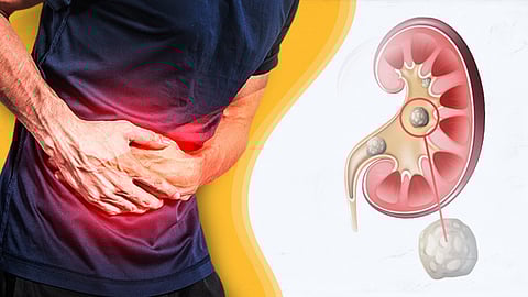 വേനൽക്കാലത്ത് വൃക്കയിൽ കല്ലുണ്ടാകാൻ സാധ്യതയേറേ; ഈ മുൻകരുതലുകൾ സ്വീകരിക്കാം