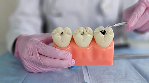 എത്ര തേച്ചിട്ടും പല്ലിൽ പോടോ? വില്ലൻ ബ്രഷിംഗ് മാത്രമല്ല; ഇതാ അറിഞ്ഞിരിക്കേണ്ട കാരണങ്ങൾ!