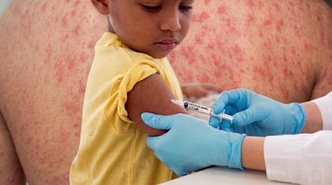 ബംഗ്ലാദേശിൽ വ്യാപകമായി ജീവനെടുത്ത് അഞ്ചാംപനി, 250 കടന്ന് മരണം; ഇന്ത്യയ്ക്കു വെല്ലുവിളിയോ?