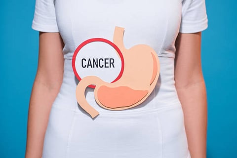 Stomach cancer begins in the stomach lining approximately 95% of the time and then expands gradually.