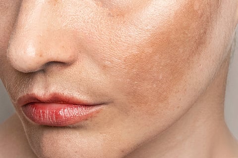 Difference between tanning and pigmentation