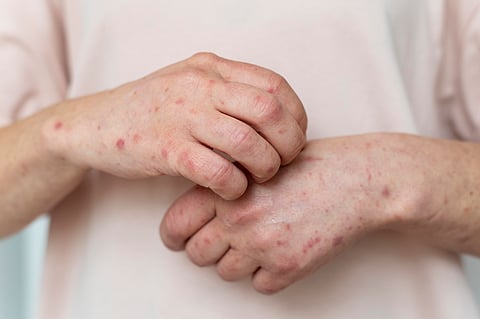 Measles Alert After Perth Christmas Carol