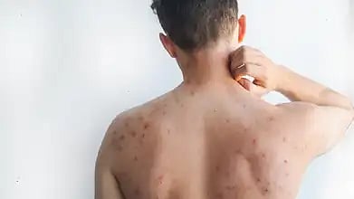 സിംഗപ്പൂരിൽ നിന്ന് എത്തിയാൾക്ക് അഞ്ചാംപനി