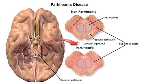 Bad dreams in older adults signal onset of Parkinson's.(Wikimedia)