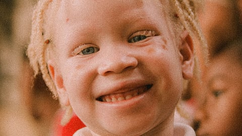 Malawi court convicts 12 people in Albino attack. (Unsplash)