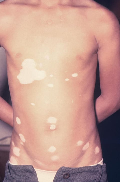Vitiligo is a chronic skin condition that causes pale white patches to appear on the skin (representational image - CDC PHIL)