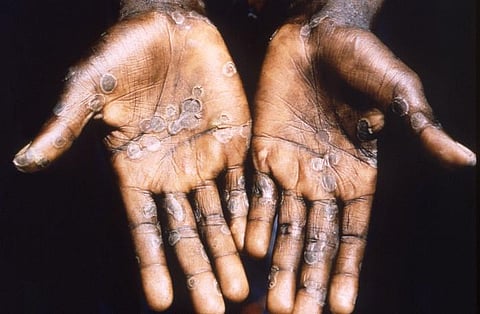 WHO says Monkeypox is Not a Global Health Emergency (representational image - CDC PHIL)