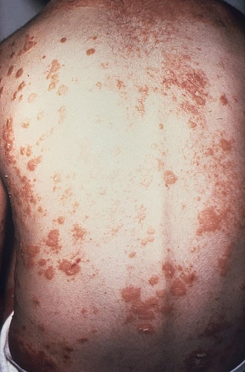 This itchy skin disease is found less in women than men (representational image - CDC PHIL)