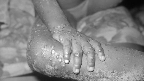 Nearly 200 cases of monkeypox have been reported in more than 20 countries not usually known to have outbreaks of the unusual disease. (Wikimedia)
