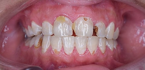 Dental caries is reported to be one of the oldest diseases in man.(Wikimedia)
