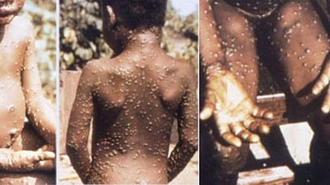 Infection control response must avoid stigmatizing the most affected patient population(representational image - Wikimedia)