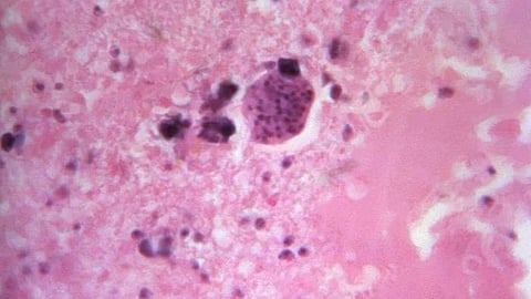 Immune targets for chemotherapy resistant breast cancers (CDC PHIL)