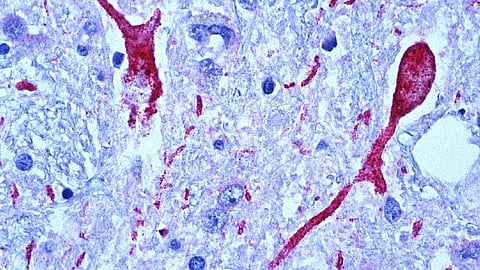 Specific brain responses to traumatic stress linked to PTSD Risk (representational image - CDC PHIL)