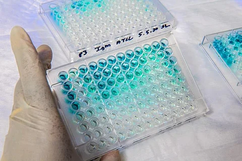 Liver diseases to be detected early with this non-invasive test (representational image - CDC PHIL)