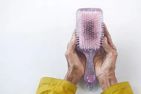 Finding the Right Treatments for Genetic Hair Loss (representational image - Unsplash)