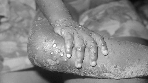 Monkey Pox declared a global emergency, here's what gives hope! (representational image - CDC PHIL)
