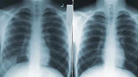 COVID or Lung Cancer? The Importance of Listening to Your Body (representational image - CDC PHIL)