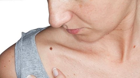 Study finds: Gene Profiling Technology Reveals Melanoma Biomarkers (representational image - Unsplash)